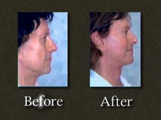 Maryland Facelift Revision Surgery Case 1 – Dr. Mark E. Rich
