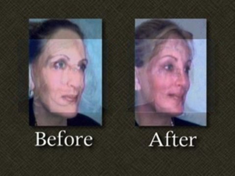 Linda Tripp Facelift Revision Surgery – Dr. Mark E. Richards