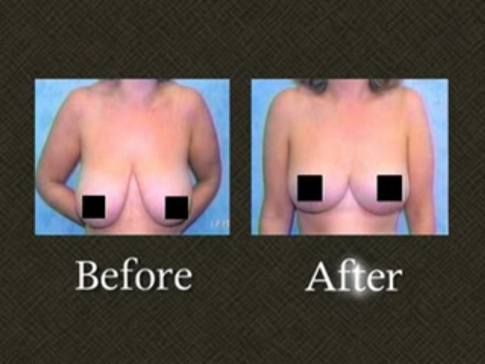 Breast Reduction Surgery Results Maryland  Dr. Mark Richards