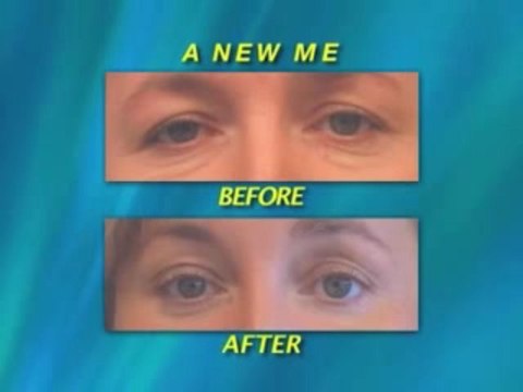 Maryland Eyelid Surgery Results Gallery - Dr. Mark Richards