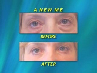 Virginia Area Plastic Surgeon Shares Cheek Lift Results