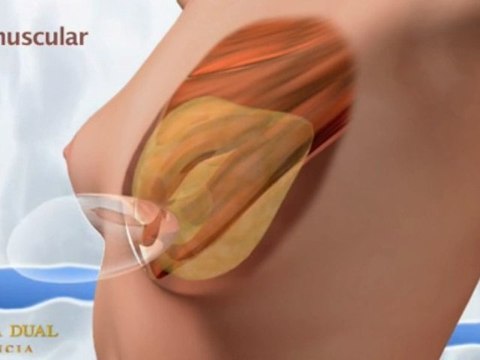 AUMENTO DE PECHOS. Mamoplastia de Aumento de Senos