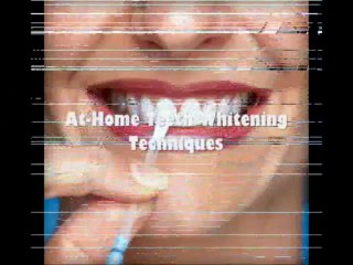 Select Natural Teeth Whitening for Discolored Teeth!!