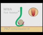 It is essential not to compress a tick when removing it