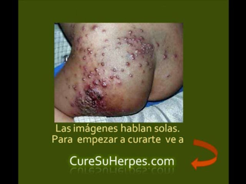 Siga el Tratamiento Exitoso Para Curar el Herpes