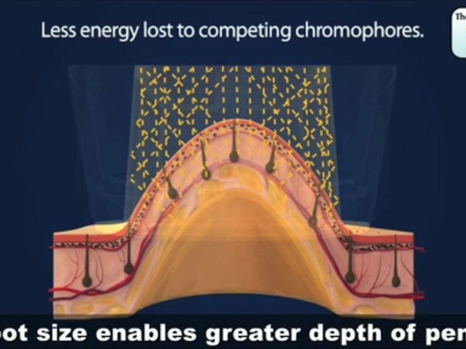 High Speed Vacuum assist Laser Hair Removal