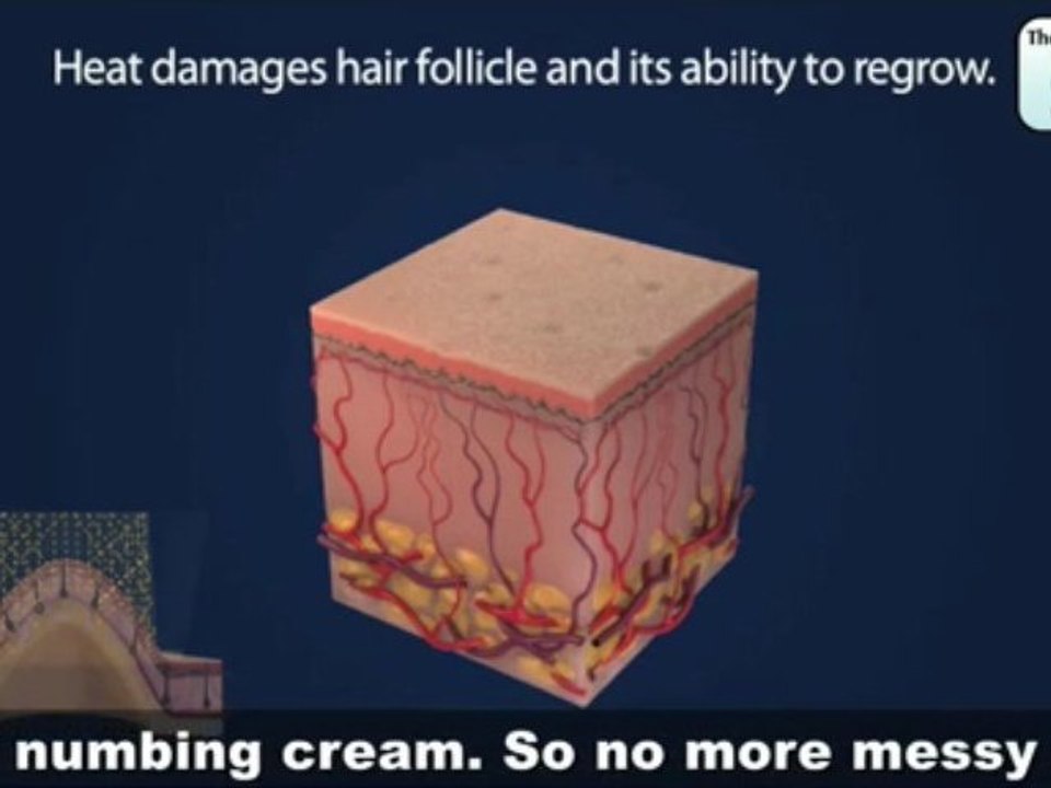 High Speed Vacuum assist Laser Hair Removal