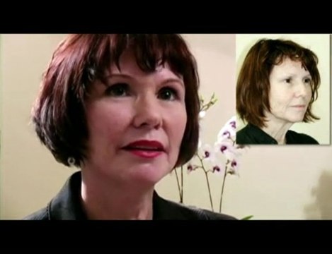 San Diego Facial Plastic Surgeon Facelift with Fat Transfer