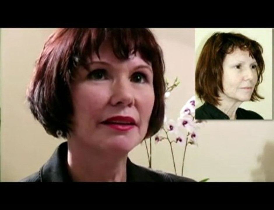 San Diego Facial Plastic Surgeon Facelift with Fat Transfer