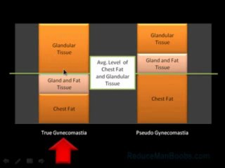 Pseudo Gynecomastia and Gynecomastia Causes