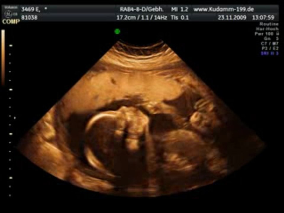 Sonographie Minimus