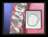Gingivitis|Teeth|Periodontal Gum Disease|Glendale|Dr. Sahabi