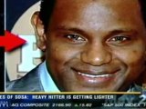 CBS 8 News San Diego: Plastic Surgeon Discusses Sammy Sosa