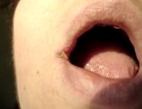Cold Sore and Herpes Treatment  How To Treat Cold Sores At H