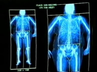 Hormonas y grasa corporal