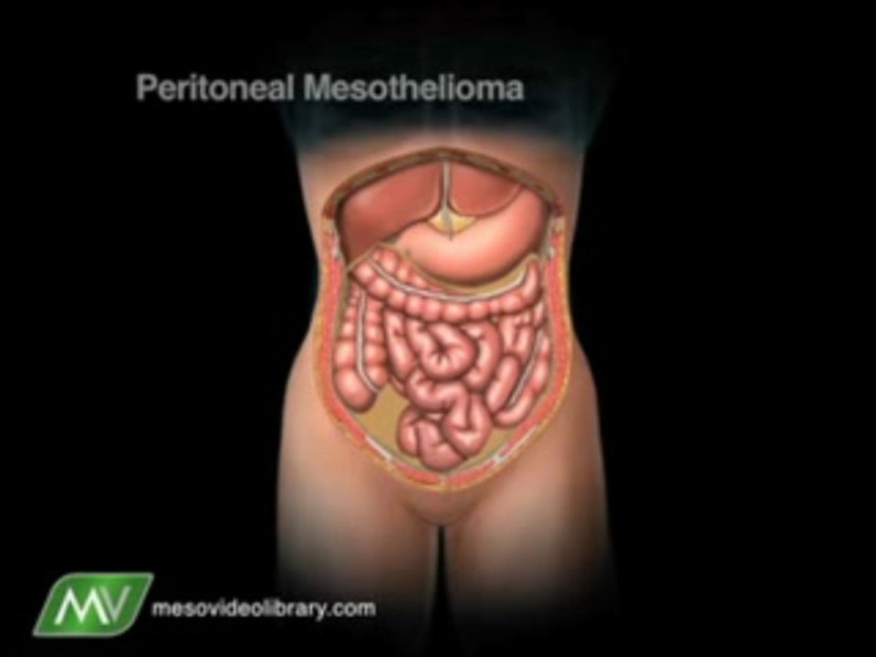 Forms of Mesothelioma