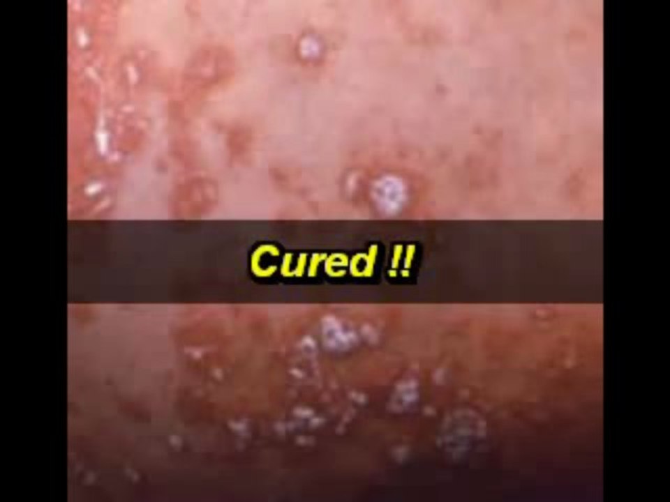 Natural yeast cure Are There Any Hoodia Gordonii Side Effect