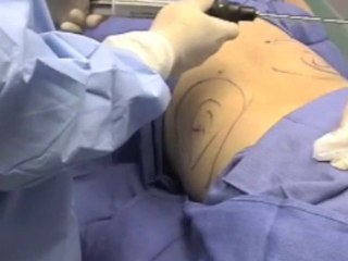 Liteshape Liposuction Procedure