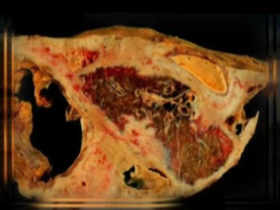 Mesothelioma Cancers