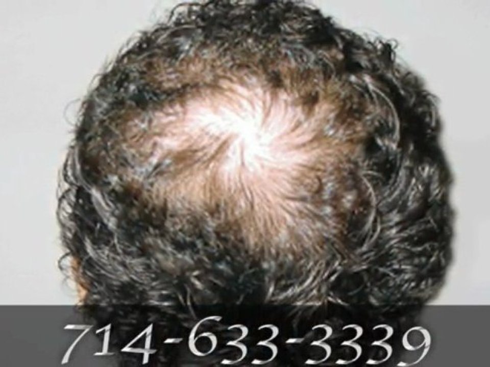 Hair Replacement Products