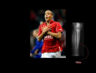 Axel de Liege - Casse tibia