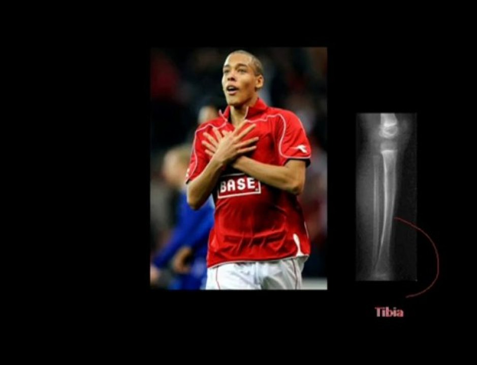 Axel de Liege - Casse tibia