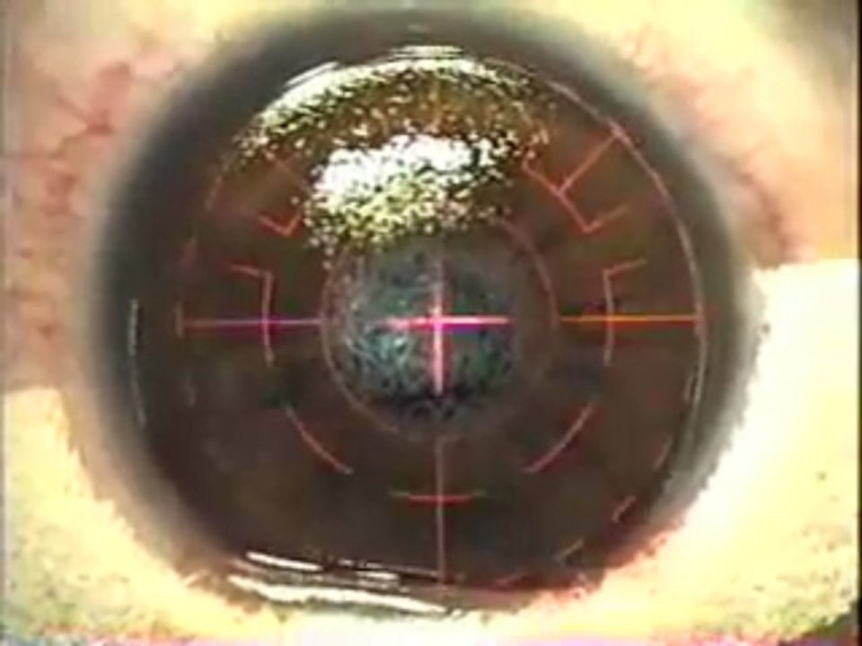 California lasik surgery Lasik Eye Surgery Procedure - Extre