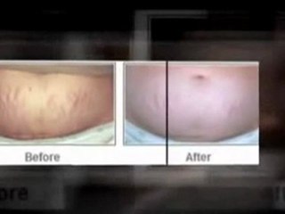 insane stretch marks on  stomach can i ever get rid of them?