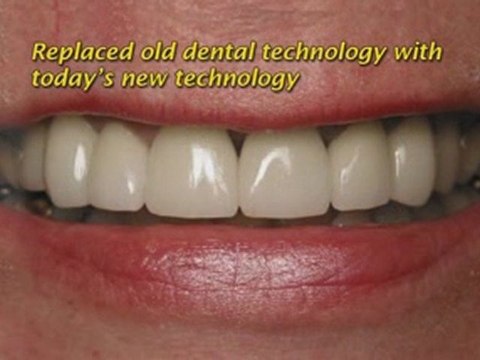 Marietta Dental Implants