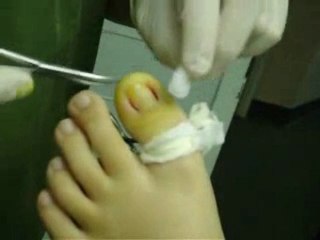 The Removal of an Ingrown ToeNail