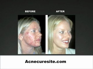 How To Get Rid of Acne Today