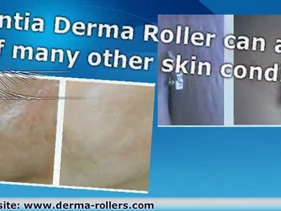 Burn Scar Removal