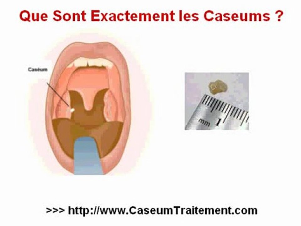 caseum-caseums-video-dailymotion
