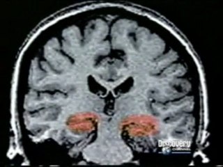 Trastorno de identidad disociativo: Estres e hipocampo