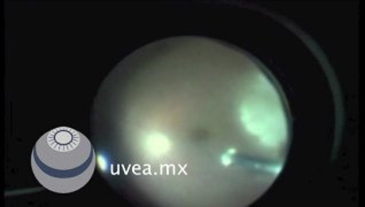 Vitrectomia posterior en Uveitis