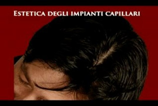 PERDITA DEI CAPELLI MASCHILE E FEMMINILE luigiuomo.com
