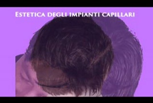 CALVIZIE MASCHILE E FEMMINILE luigiuomo.com