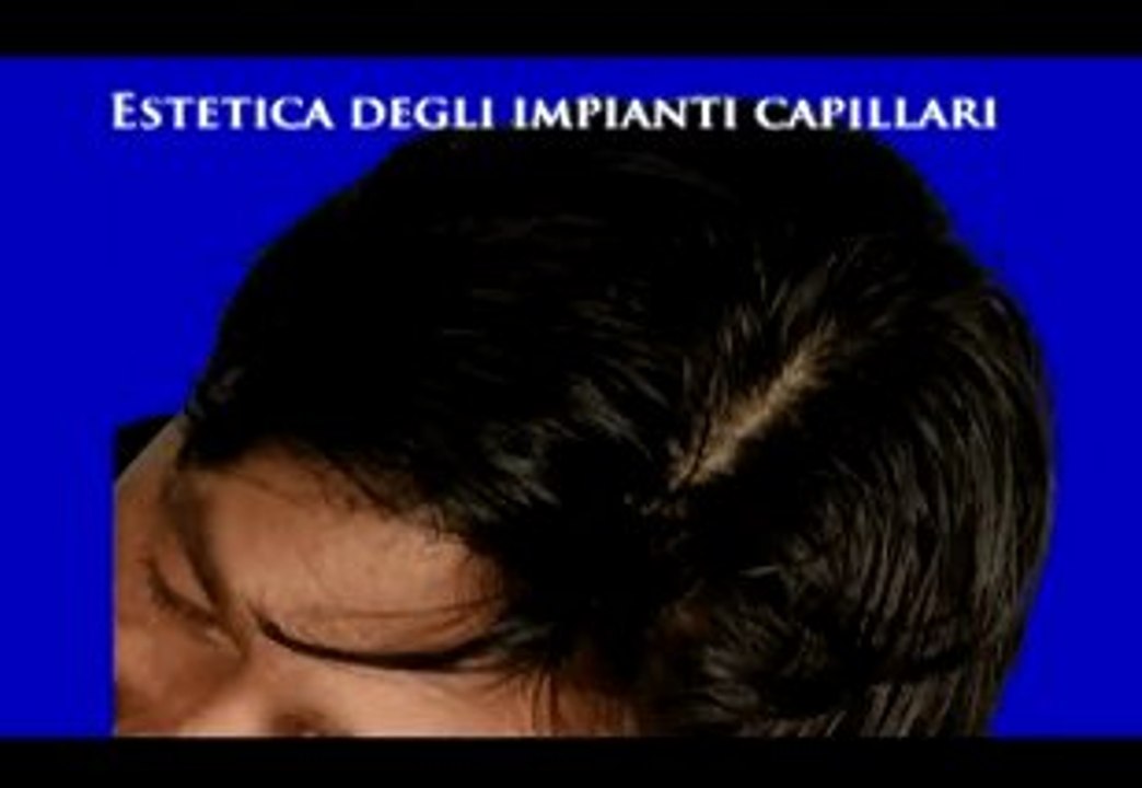IMPIANTI CAPILLARI PER UOMO E DONNA www.luigiuomo.com