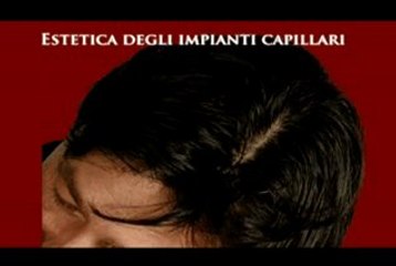 ALOPECIA ANDROGENETICA MASCHILE E FEMMINILE www.luigiuomo.co
