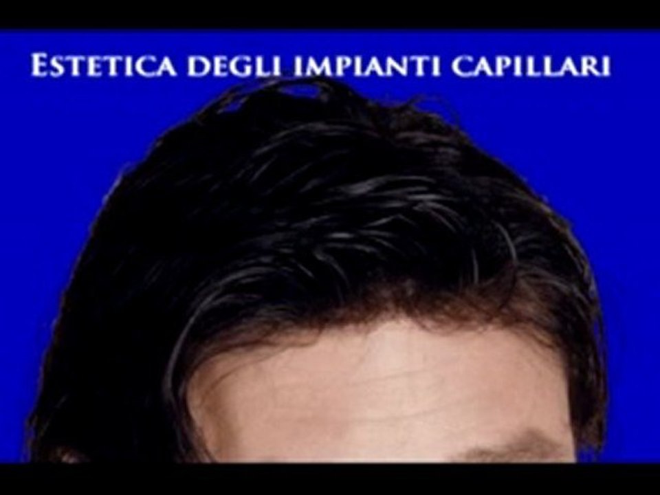 TRAPIANTI DEI CAPELLI www.luigiuomo.com