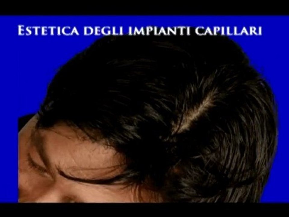 FERMARE LA CADUTA DEI CAPELLI www.luigiuomo.com