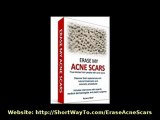 Acne Scar Removal - Why You Must Read ERASE MY ACNE SCARS