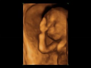 Selda ve Özer'in oğlu (4 Boyutlu Ultrason)