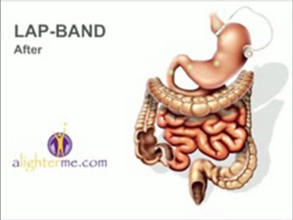 Lapband Surgery