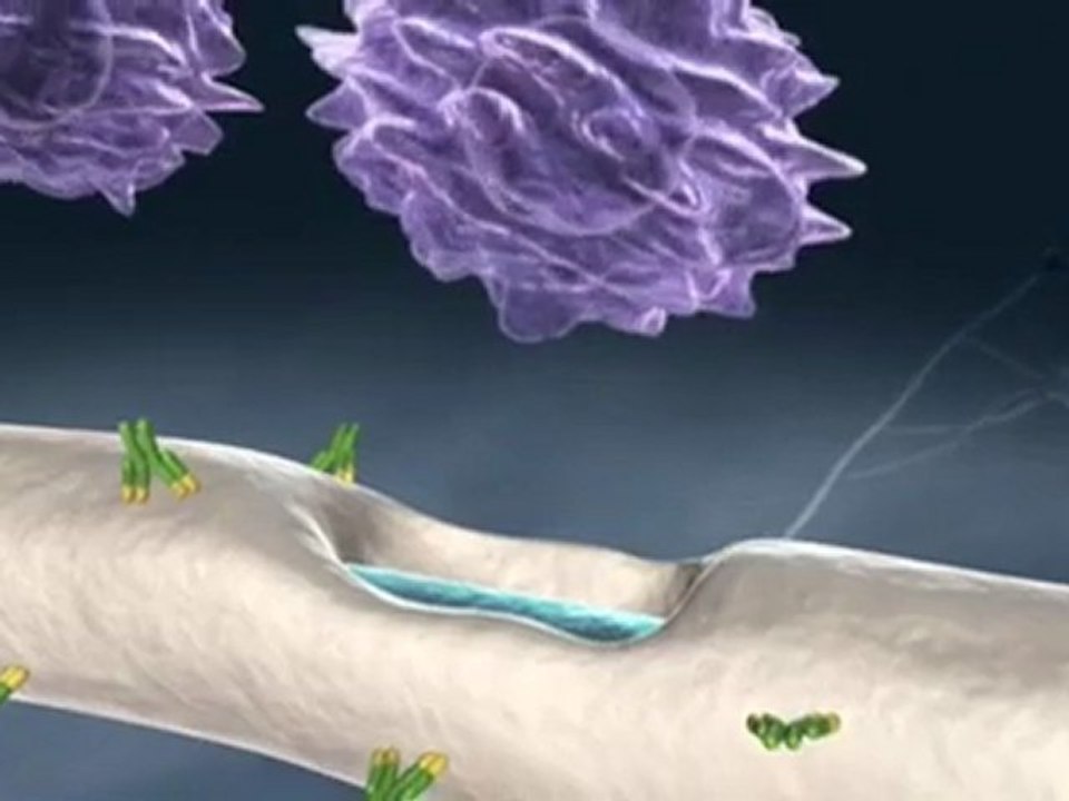 Esclerosis multiple (v.o. ingles)