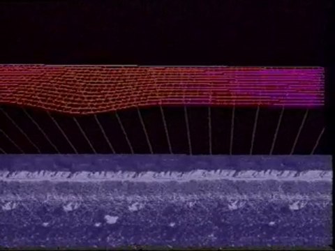 Bruit et santé : Cellules ciliées externes endommagées