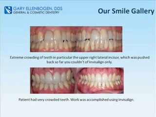 Cosmetic Dentistry by Vienna Virginia Dentist Gary ...