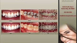 Cosmetic Dentistry by Federal Way WA Cosmetic Dentist ...