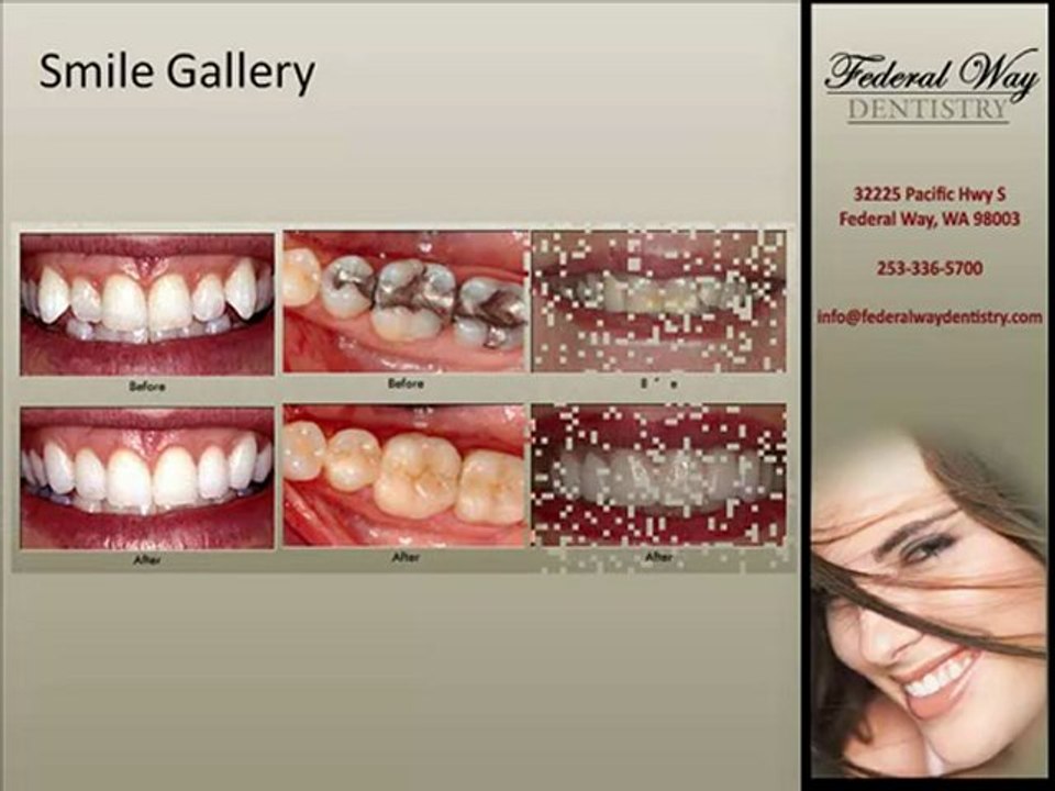 Cosmetic Dentistry by Federal Way WA Cosmetic Dentist ...