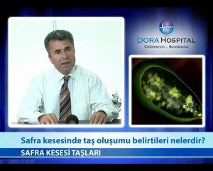 Safra Kesesinde Taş Oluşumu Belirtileri Nelerdir?